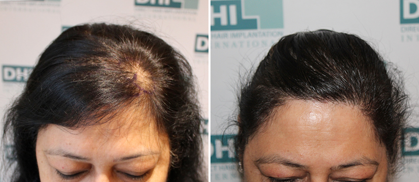 DHI before & after hair transplant results